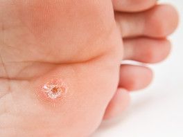 Plantar Warts